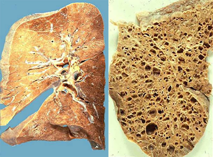 Photo of Lungs with IPF